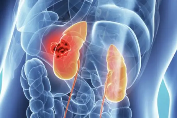 Kidney & Urological Cancers: Hematuria Evaluation, Partial Nephrectomy & Bladder Care